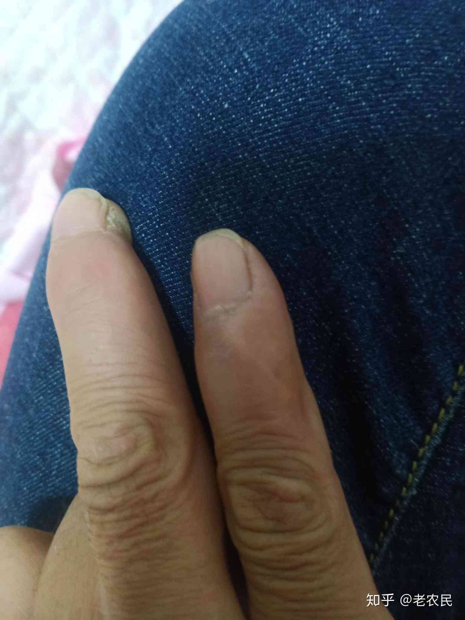 手指轻微骨裂可以认定工伤