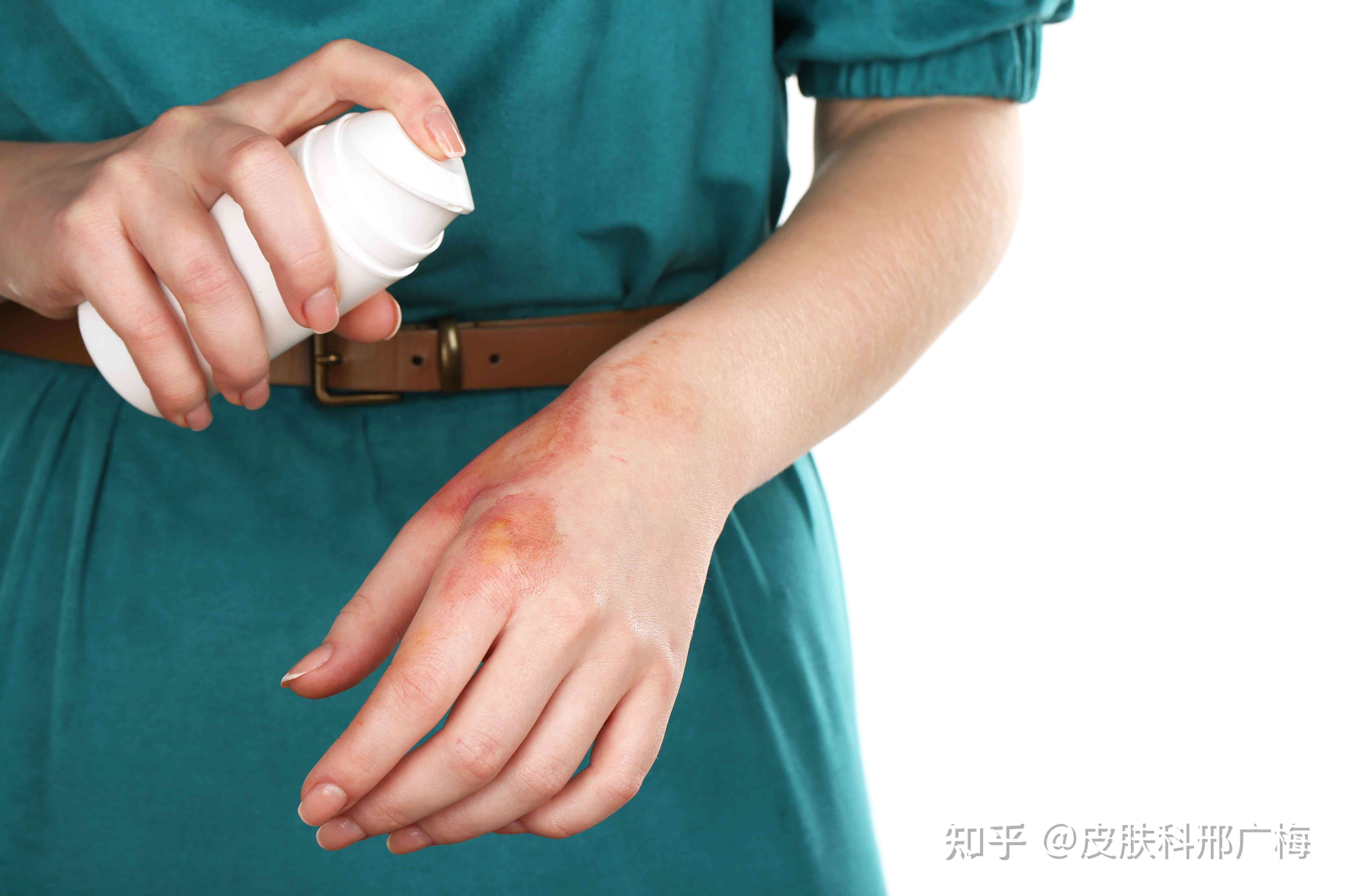 手挫伤一般需要多久恢复：如何加速痊愈时间与完全恢复周期