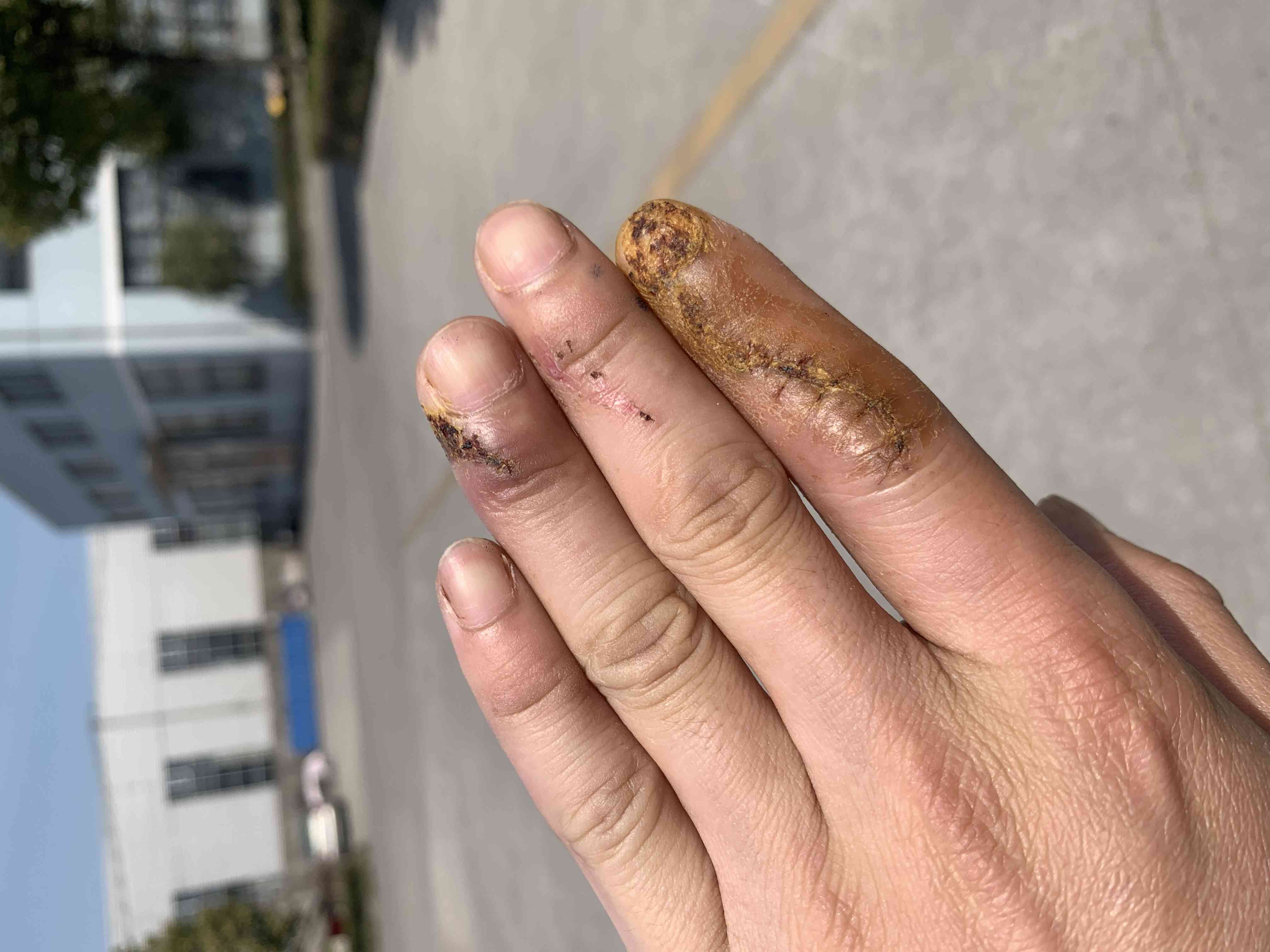 手部擦伤破皮工伤认定标准及赔偿流程详解：如何申请赔偿与     指南