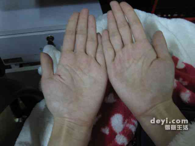 手擦破皮了会留疤吗：如何处理及预防留疤和流血问题