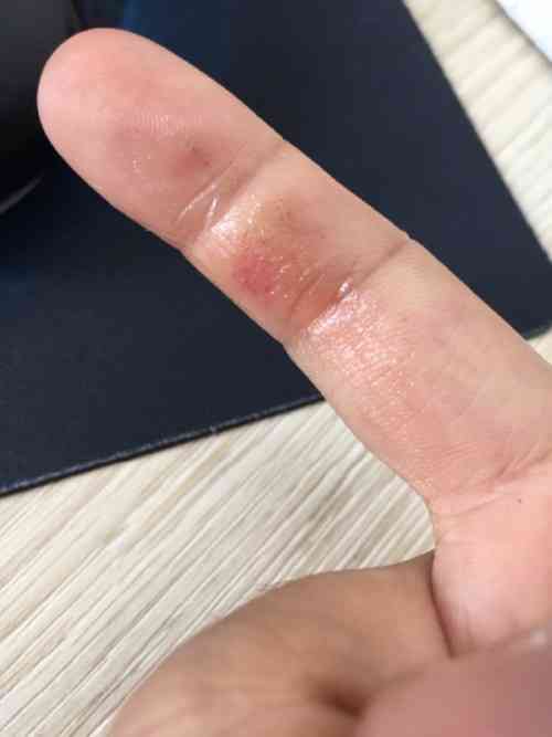 手擦破皮了会留疤吗：如何处理及预防留疤和流血问题