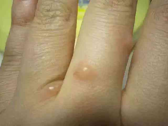 手擦破皮了会留疤吗：如何处理及预防留疤和流血问题