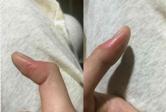 手擦破皮了会留疤吗：如何处理及预防留疤和流血问题