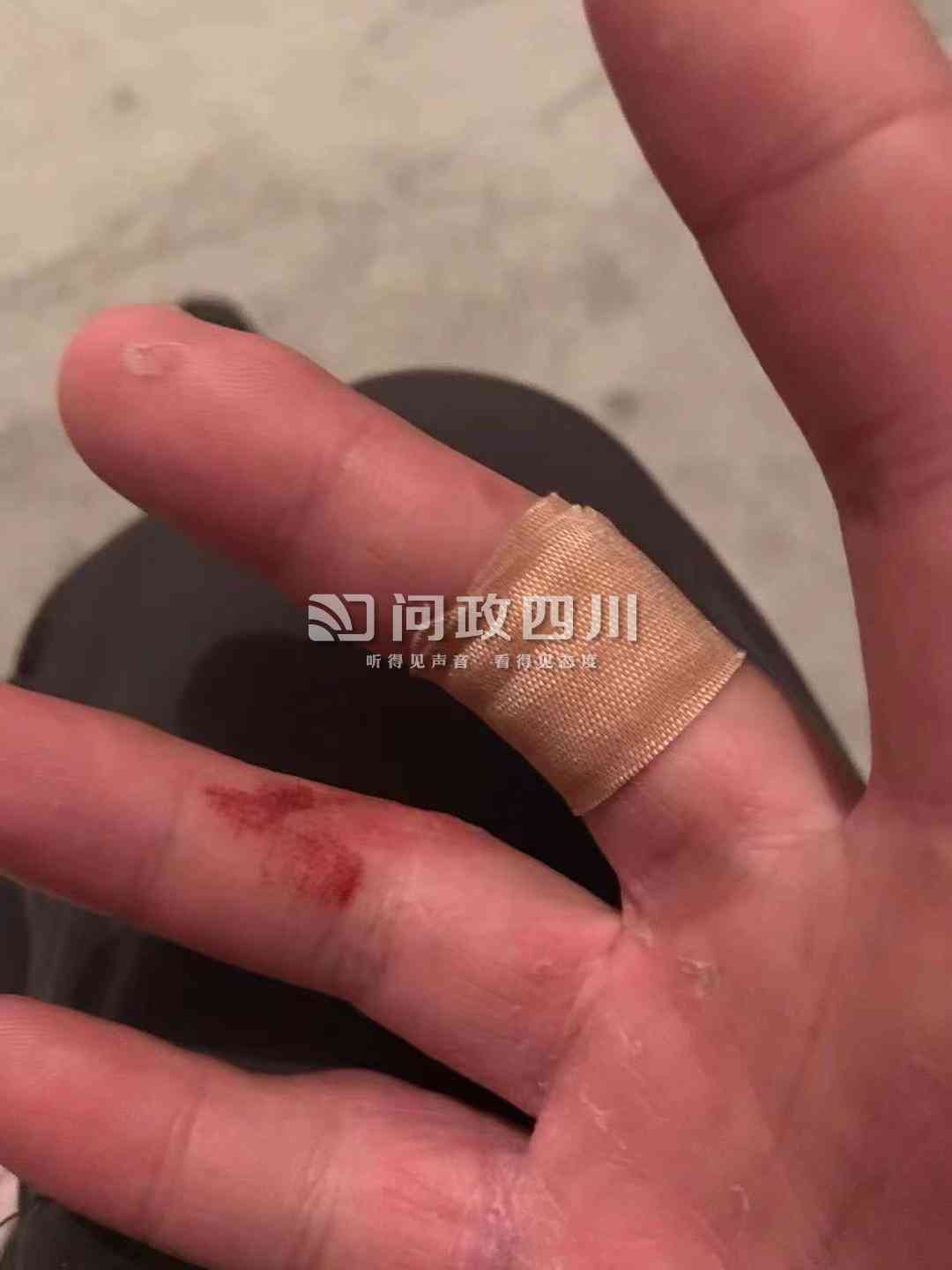 手擦破皮能认定工伤吗