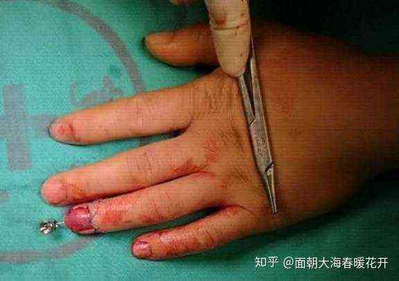 手断了多久能动，恢复时间及恢复至能做重活所需时长