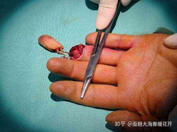 手断了多久能动，恢复时间及恢复至能做重活所需时长