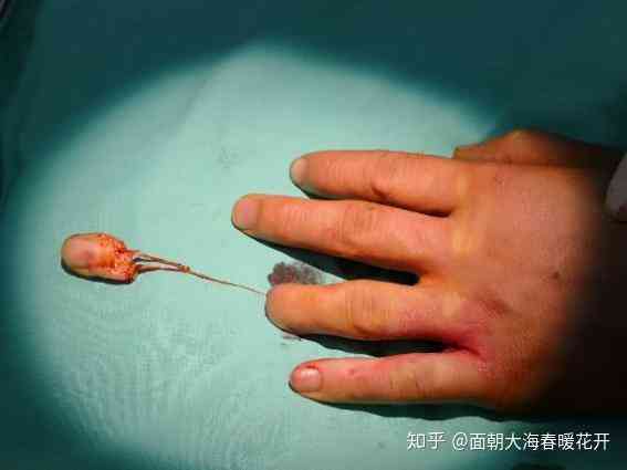 手断了多久能动，恢复时间及恢复至能做重活所需时长