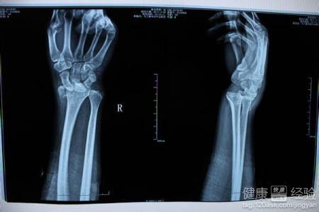 '手腕骨折恢复周期：断手损伤后复时长解析'