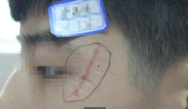 全方位解析：手术疤痕的治疗方法与改善策略