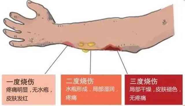 工伤等级判定：手部烫伤工伤级别的详细划分与认定标准