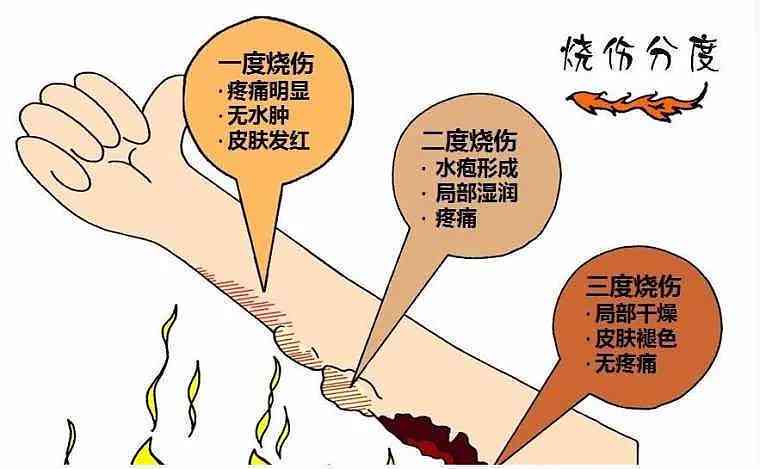 职场安全解析：手部烫伤是否构成工伤认定标准