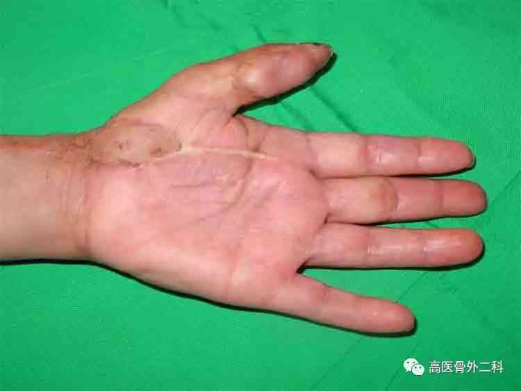 手背植皮影响到手的功能吗？术后功能恢复情况分析