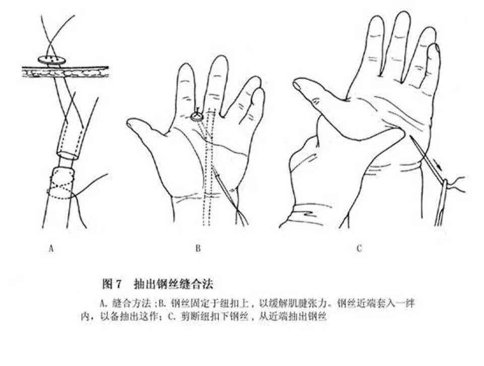 手背肌腱断裂算伤残吗：如何赔偿及是否构成轻伤的标准