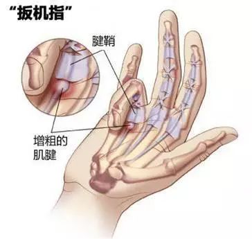 手背肌腱断裂算伤残吗：如何赔偿及是否构成轻伤的标准