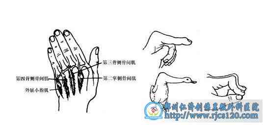手背肌腱断裂后手指活动能力及复情况详解