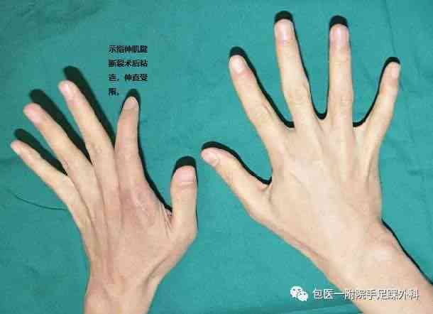 手背肌腱断裂后手指活动能力及复情况详解