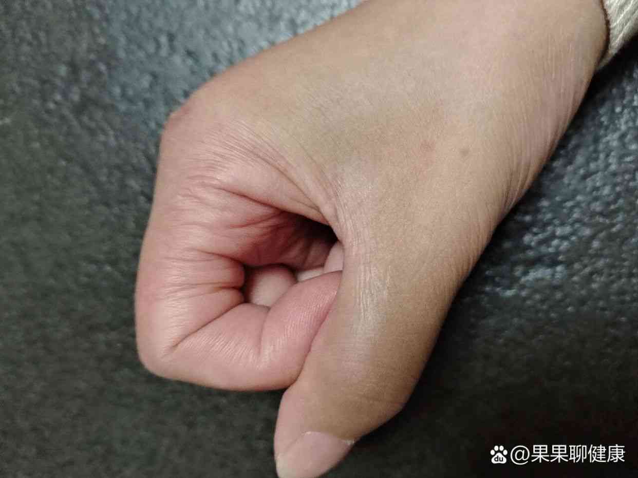 手背肌腱断裂后手指活动能力及复情况详解