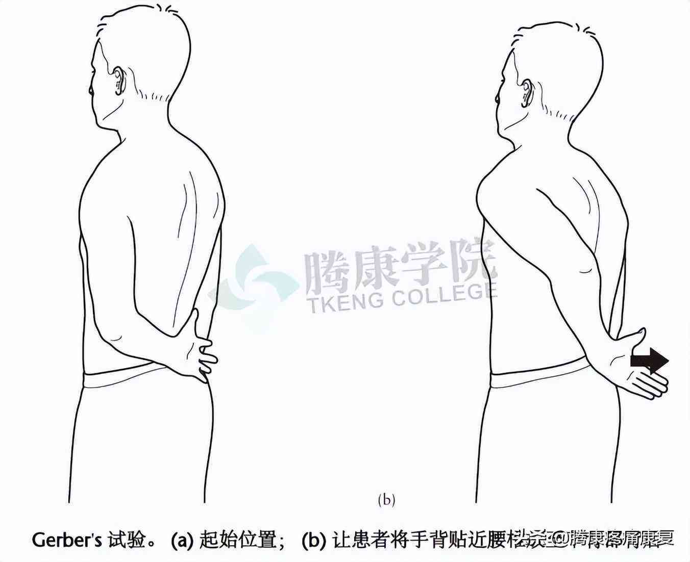 手背肌腱断裂后遗症很大吗：二次断裂几率、治疗及能否治愈探讨