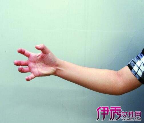 手腕摔伤会有后遗症吗：治疗与恢复时长解析