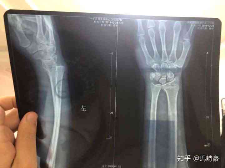 手腕摔伤手指能动算骨折吗：手腕不能转但手指能弯曲伸直多久能恢复？