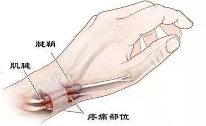 '手腕腱鞘炎工伤认定条件及赔偿金额解析'