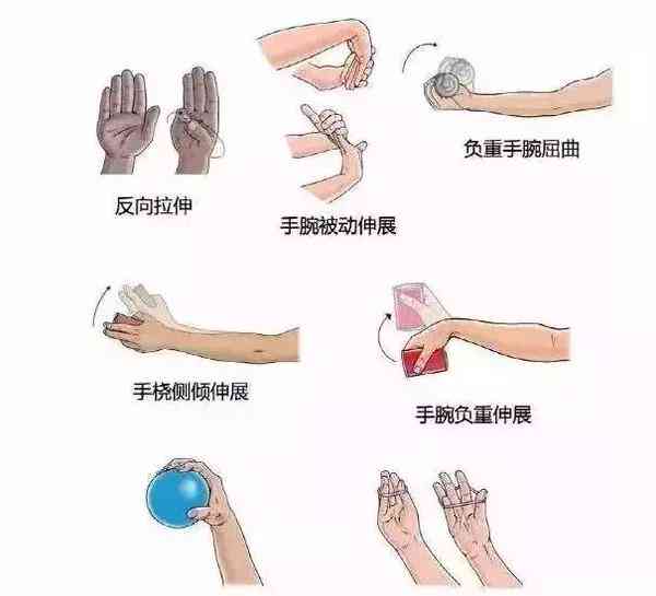 手腕腱鞘炎：工伤认定标准、申请流程与常见疑问解答