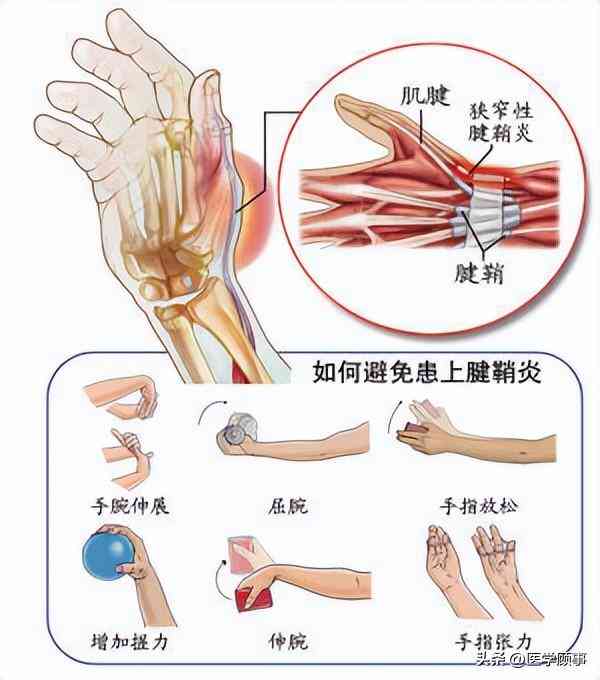 手腕腱鞘炎：工伤认定标准、申请流程与常见疑问解答
