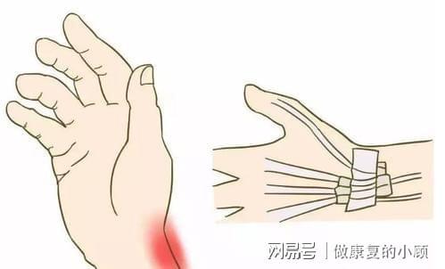 手腕腱鞘炎：评估其伤残等级及劳动能力影响