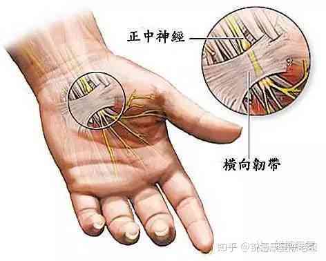 手腕腱鞘炎手术全解析：适应症、术式选择、恢复与费用指南
