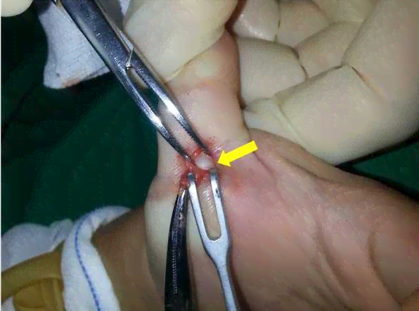 手腕腱鞘炎可以正常上班吗——女性患者能否工作及是否能从事重活？