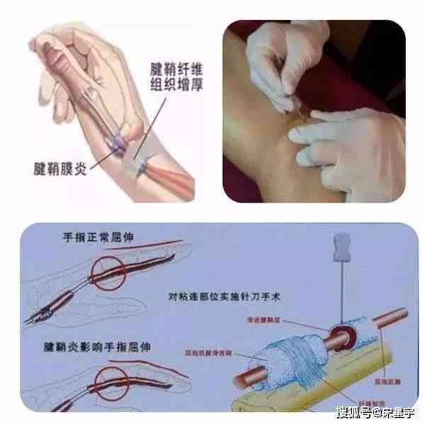 手腕腱鞘炎可以正常上班吗——女性患者能否工作及是否能从事重活？