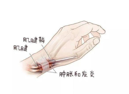 手腕腱鞘炎可以正常上班吗——女性患者能否工作及是否能从事重活？