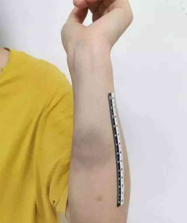 手臂缝针手术评定：详解伤残等级判定标准