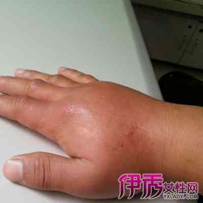 手被砸伤了怎么消肿：最快止痛消肿方法及快速消肿技巧