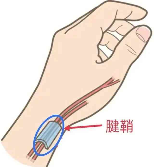 探讨腱鞘炎：它是否被归类为职业病及工作相关工伤？