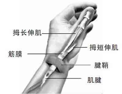 探讨腱鞘炎：它是否被归类为职业病及工作相关工伤？