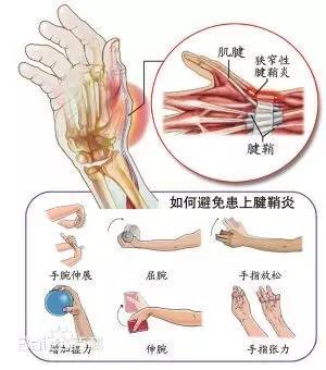 手部腱鞘炎可以认定工伤吗