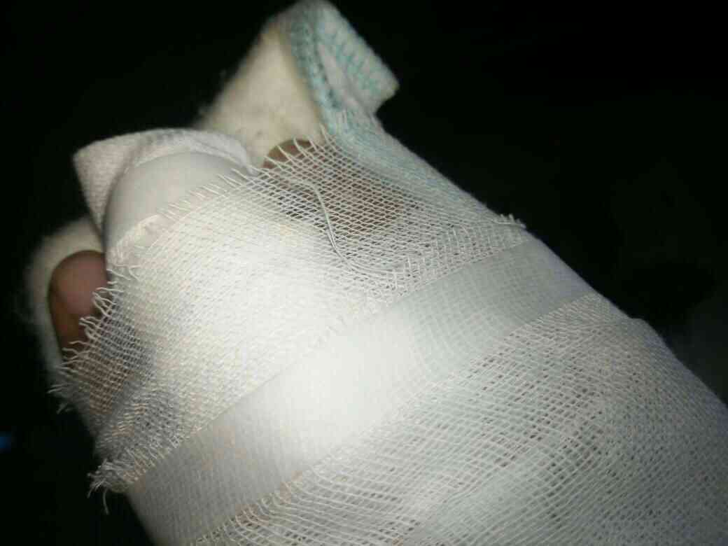 手骨头碎裂可以认定工伤吗