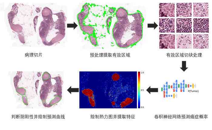 人工智能在乳腺癌病理报告中的应用与优势：提升诊断准确性与效率