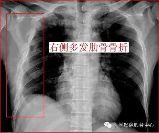 打架工伤鉴定标准：肋骨骨折认定及最新详细程度说明-打架肋骨骨折伤残鉴定标准及赔偿