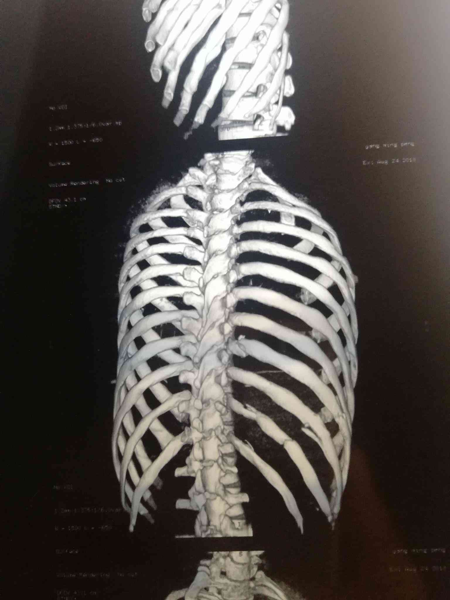 打架工伤鉴定标准：肋骨骨折认定及最新详细程度说明-打架肋骨骨折伤残鉴定标准及赔偿