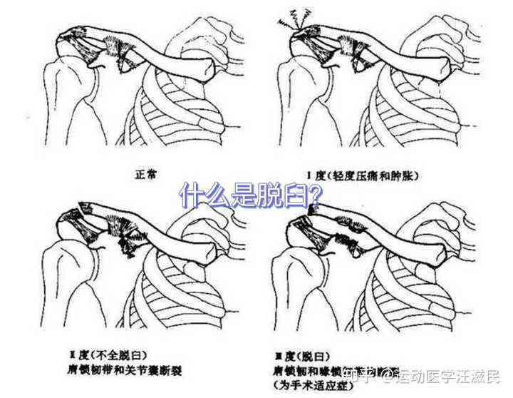 打球致肩关节脱臼工伤等级判定及赔偿标准解析
