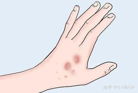 '扭伤复缓慢：探究为何关节扭伤难以痊愈的奥秘'