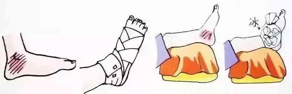 扭伤性膜炎复周期详解：治疗时长、恢复步骤与注意事项