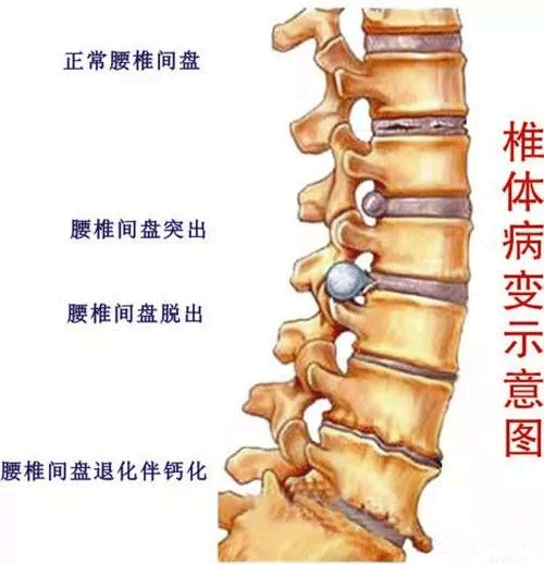 腰椎突出由扭伤引发，能否认定为工伤及赔偿金额解析