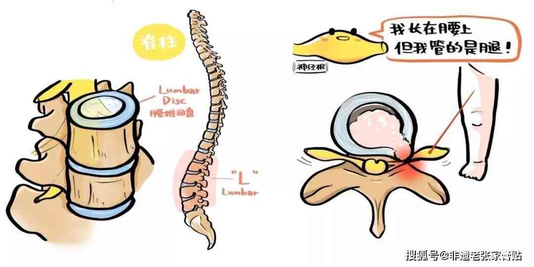 搬重物导致腰椎膨出，能否认定为工伤案例解读