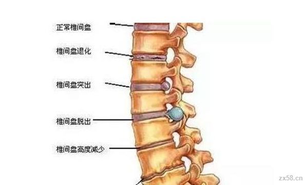 工作中抬重物导致腰椎间盘突出，如何判断是否构成工伤及应对措