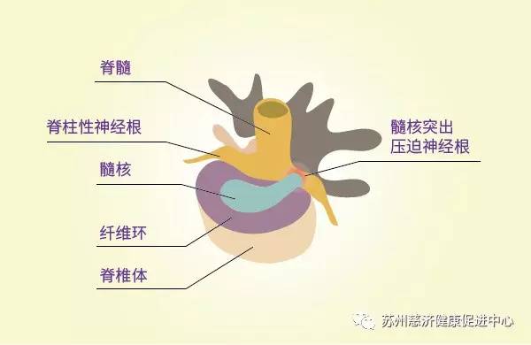 工作中抬重物导致腰椎间盘突出，如何判断是否构成工伤及应对措