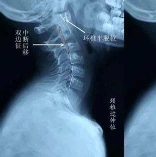 腰椎抬重物损伤预防与复指南：全面解析原因、症状及治疗方法