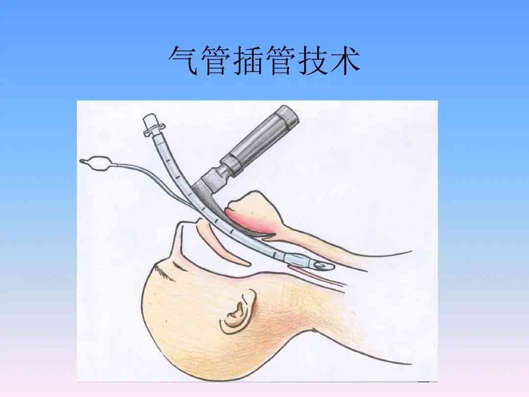 气管插管拒绝救治情况下的工伤事故认定探讨